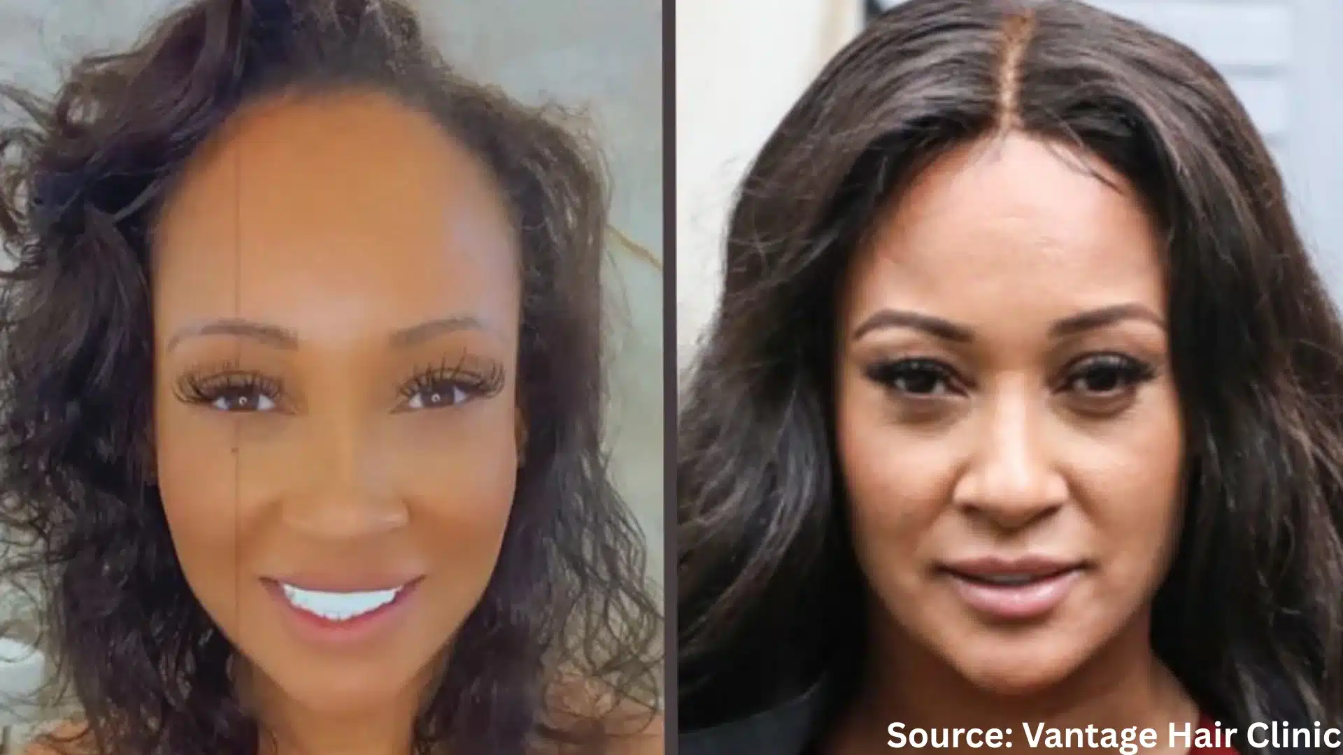 Lisa Maffia hair transplant before and after