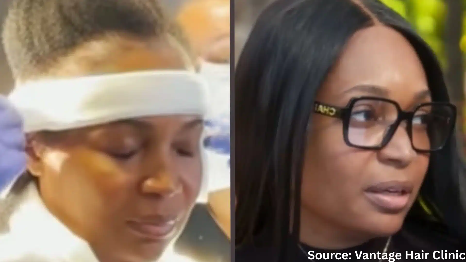 Marlo Hampton hair transplant before and after