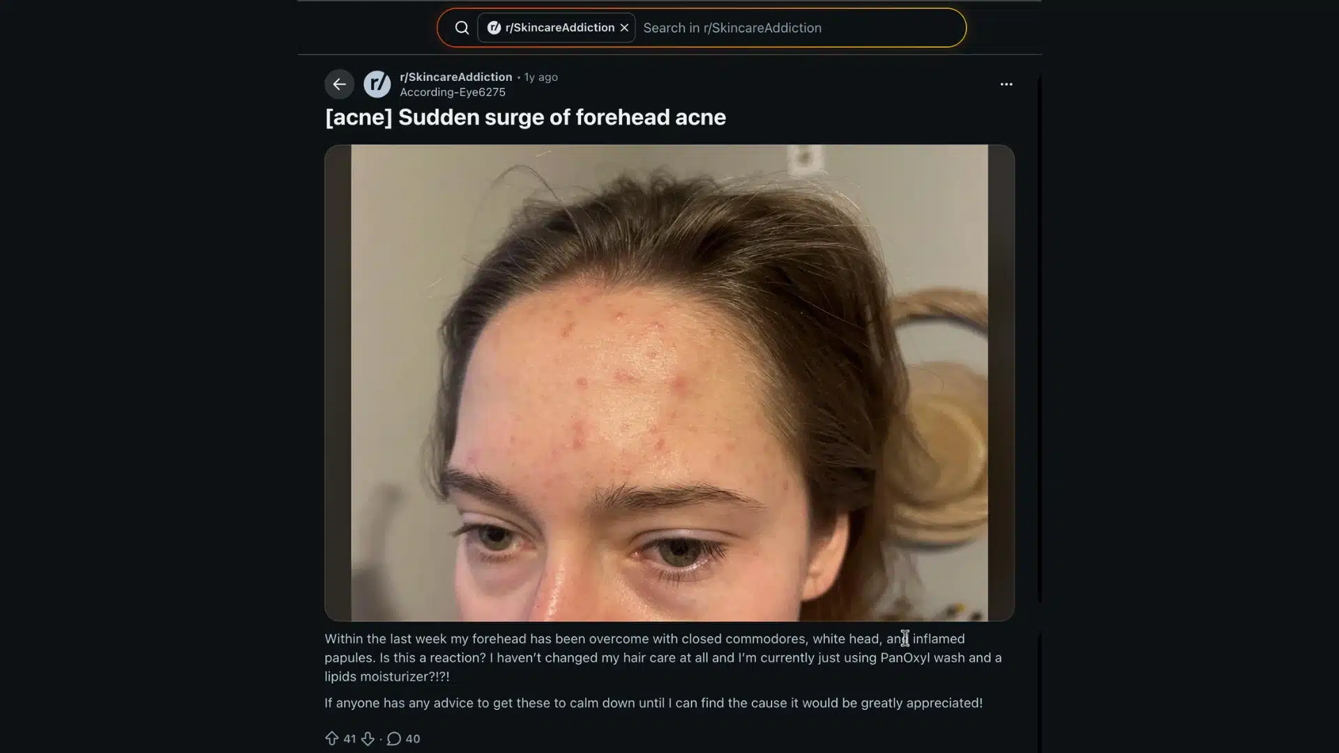 Reddit post showing sudden forehead acne breakout with user discussing causes and seeking advice on unexpected skin flare-ups