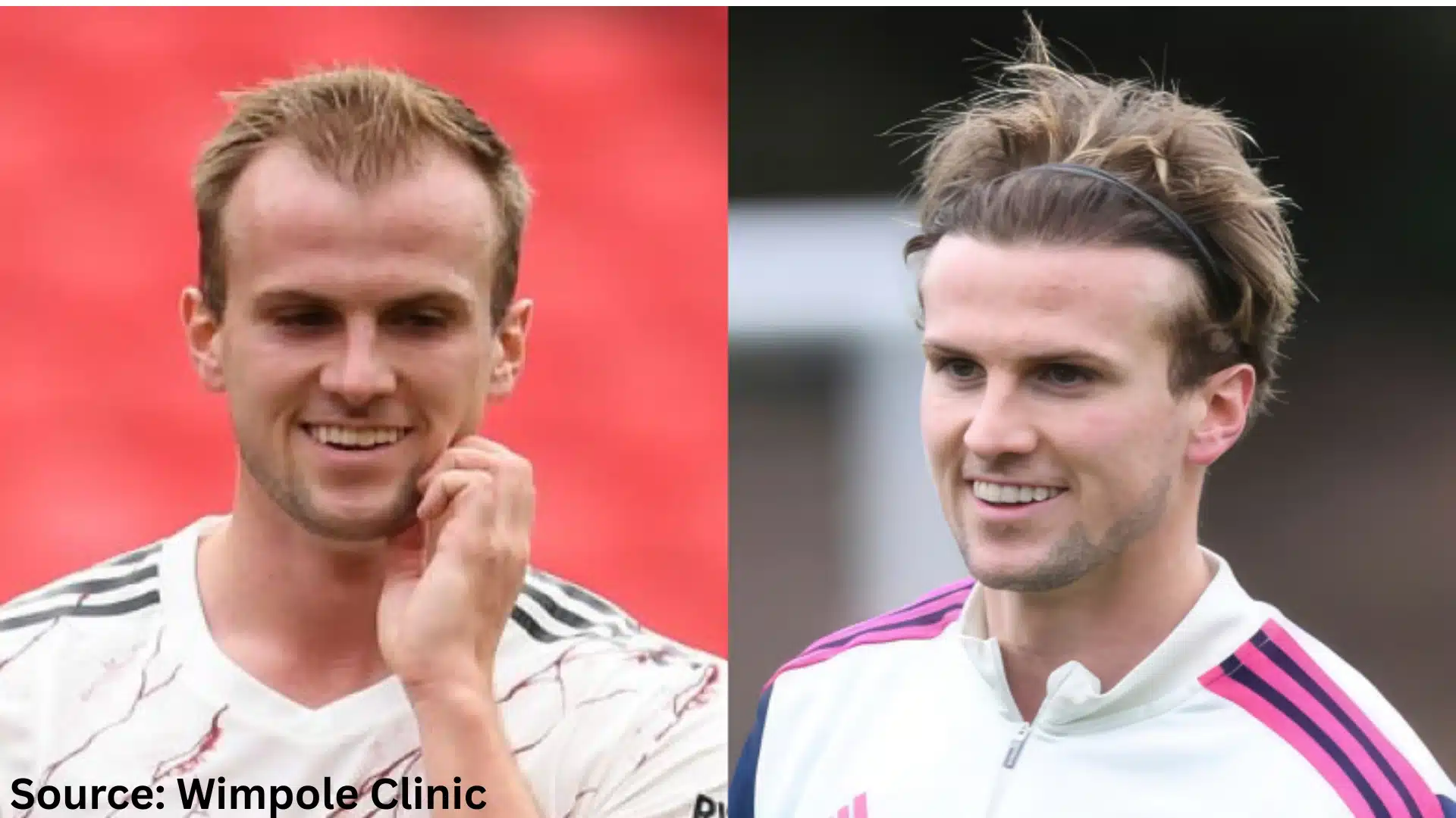 Rob Holding hair transplant before and after