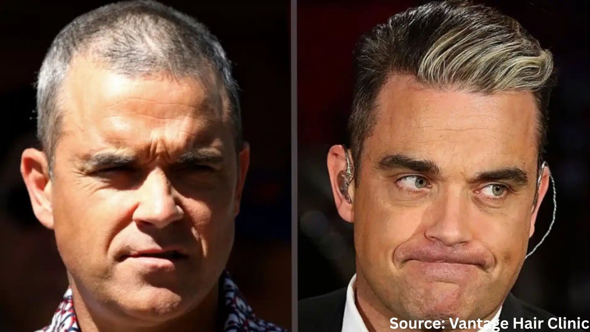 Robbie Williams hair transplant before and after