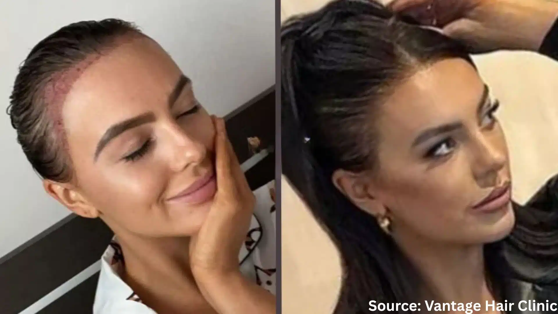 Rosie Williams hair transplant before and after