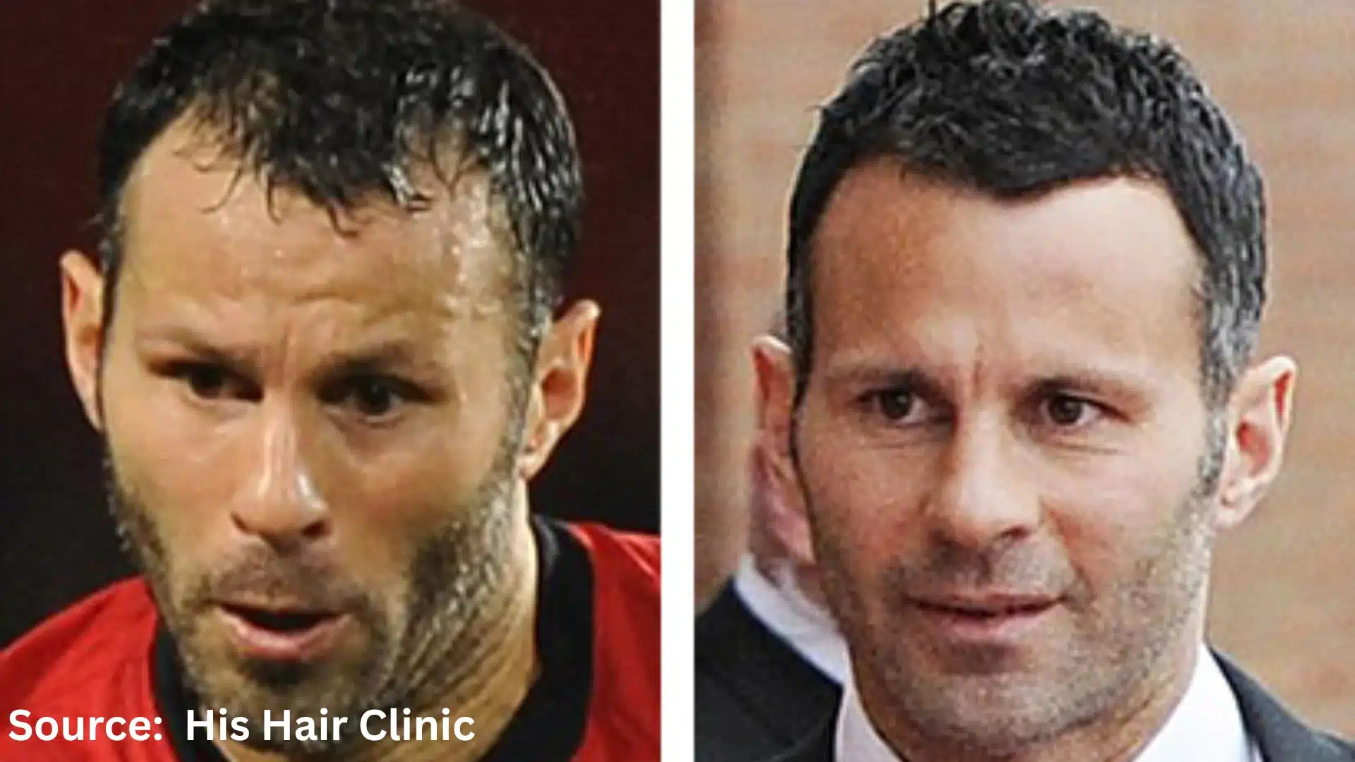 Ryan Giggs hair transplant before and after