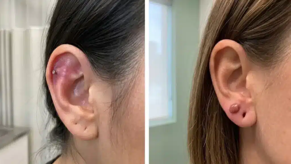 Side-by-side comparison of keloid scars or bumps formed on the upper cartilage and lower lobe of pierced ears