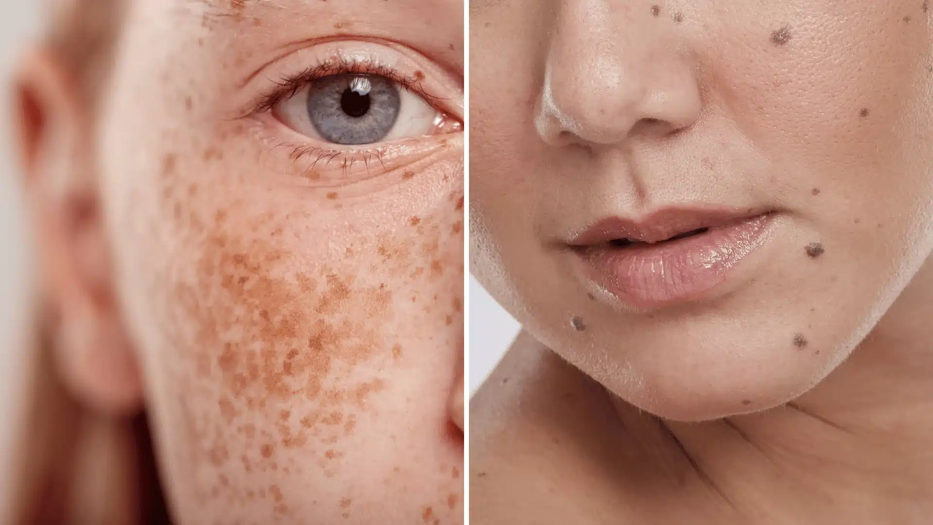 Side by side close up of facial freckles and moles showing differences in color, size, and placement