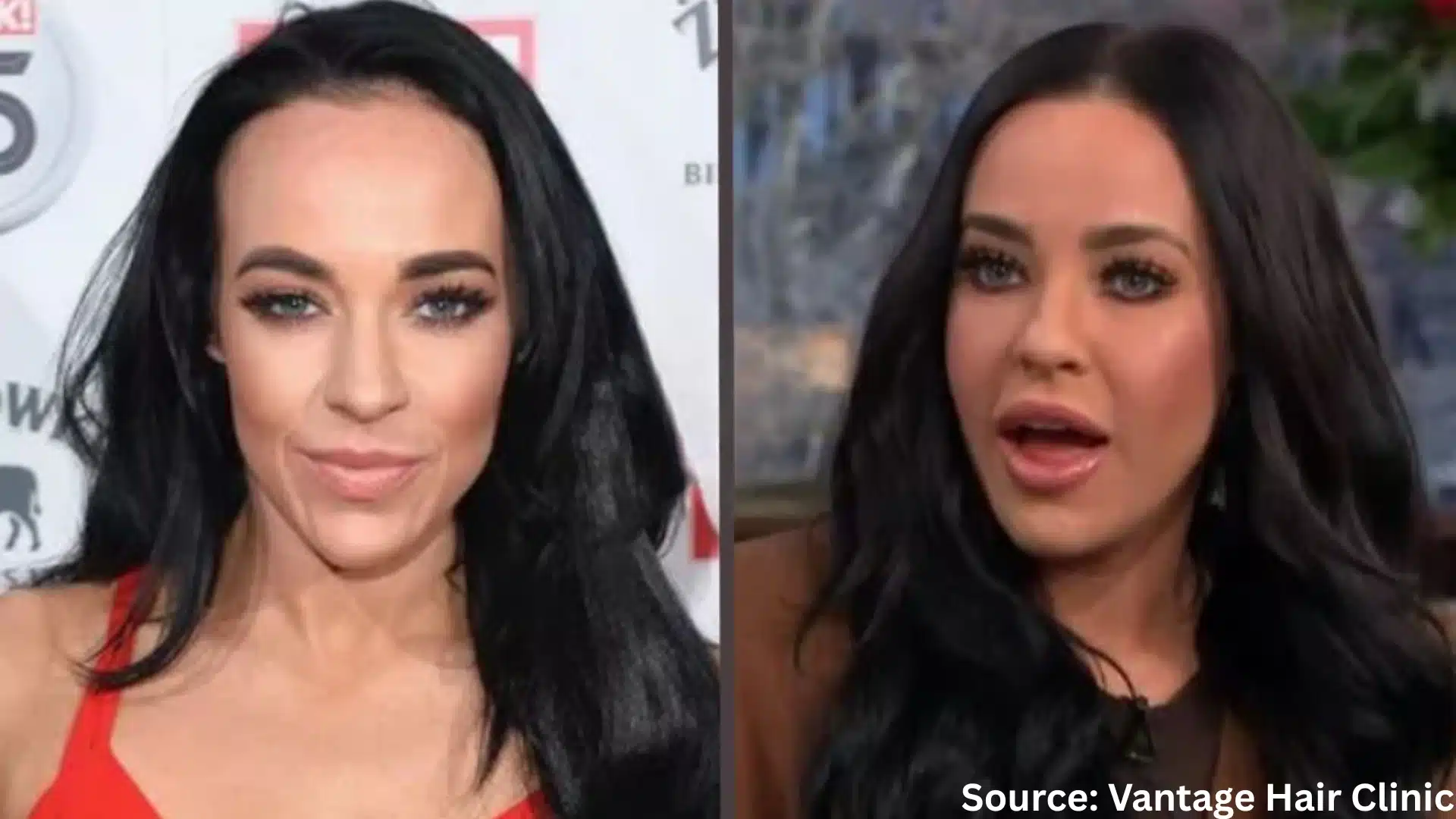 Stephanie Davis hair transplant before and after