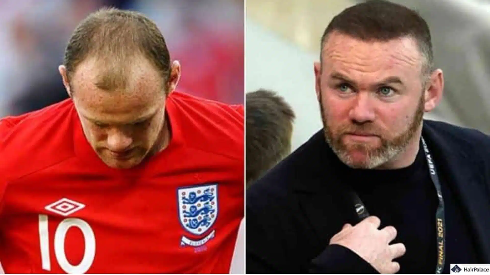 Wayne Rooney hair transplant before and after