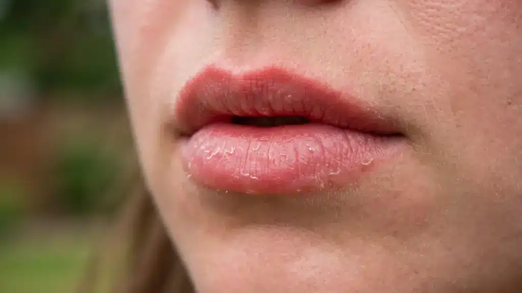 A close-up view of a person's dry, cracked lips showing visible flaking skin against a soft-focus outdoor backdrop