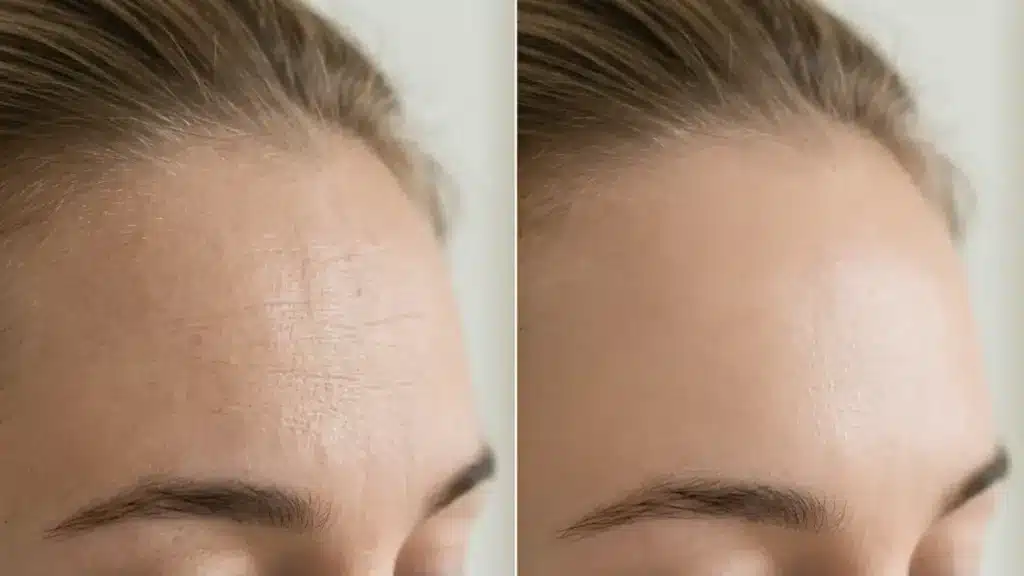 Close-up before and after comparison of smooth forehead skin, soft clinical lighting, no faces fully shown, neutral skin tones, no text overlay, realistic photography sty