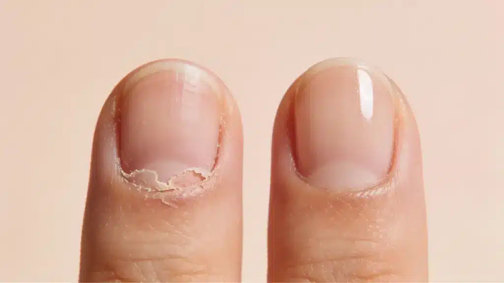 Dry peeling cuticle beside a smooth healthy nail on a soft peach background