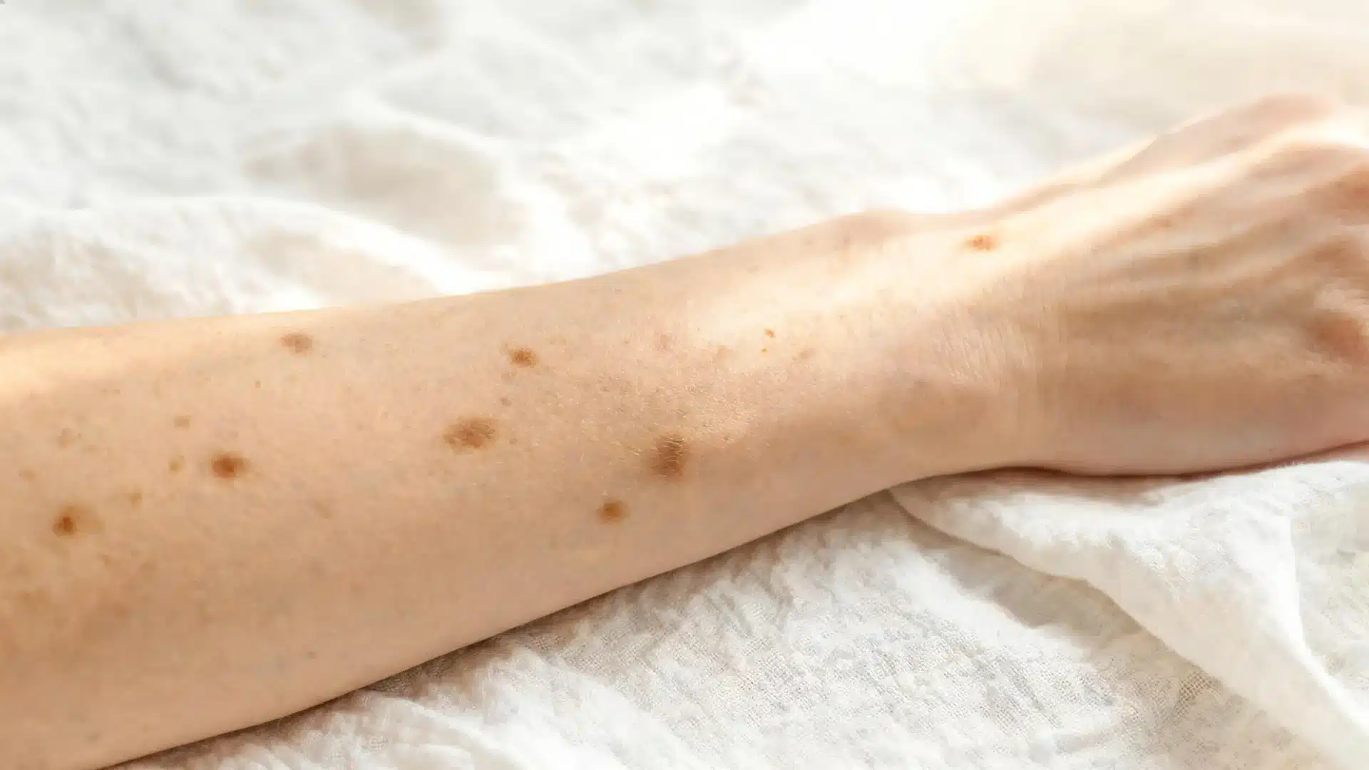 Forearm with multiple dark age spots and sun damage marks resting on a light fabric surface