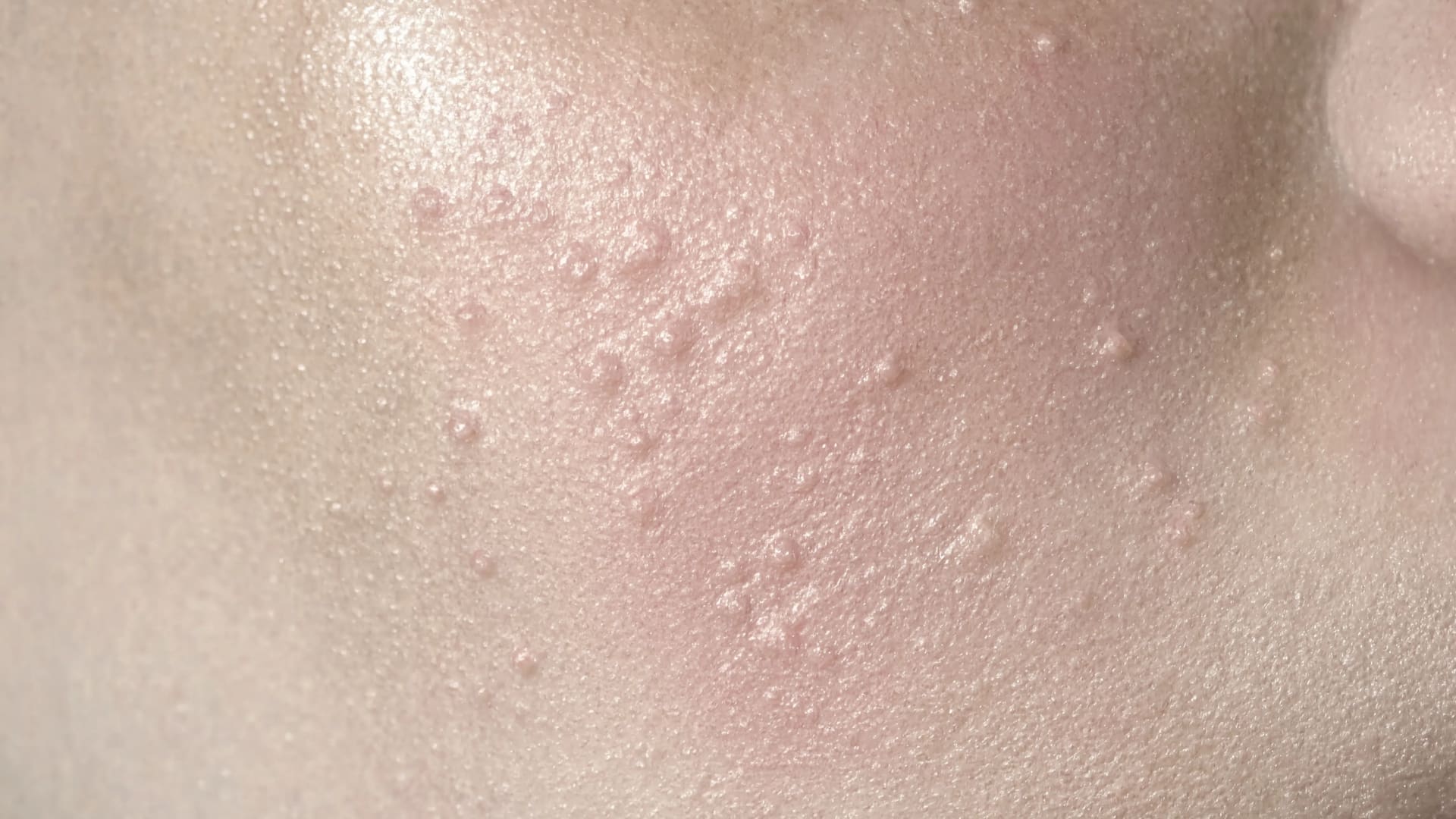Macro skin with white bumps showing a cluster of small milia bumps on a textured cheek
