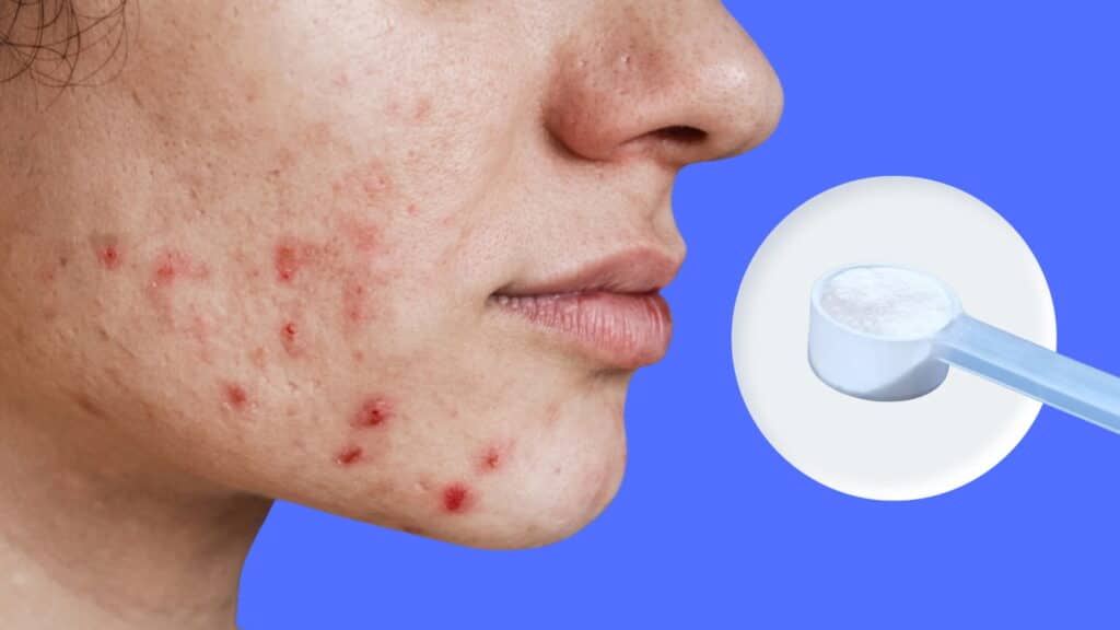 severe skin breakout with acne beside a creatine scoop in a circle