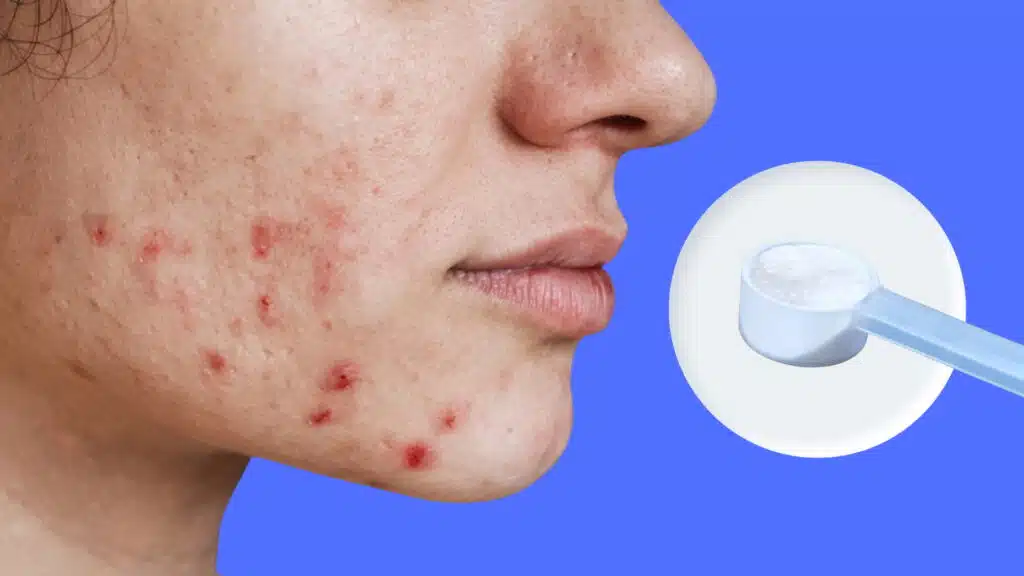 severe skin breakout with acne beside a creatine scoop in a circle