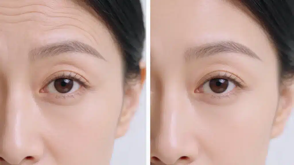 Split-screen image showing forehead wrinkles before and after treatment