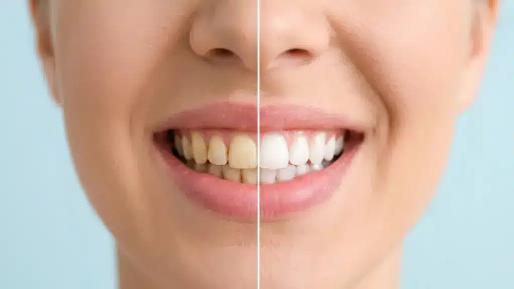 Split view of a woman's smile showing yellow, stained teeth on the left and bright white teeth on the right