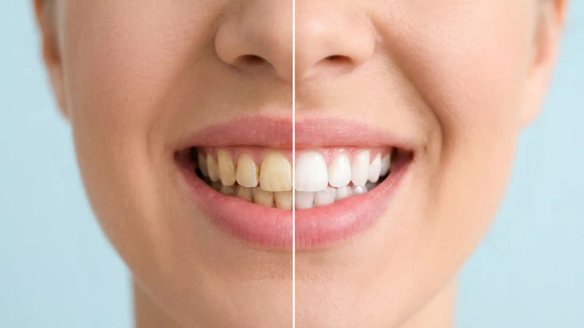 Split view of a woman's smile showing yellow, stained teeth on the left and bright white teeth on the right