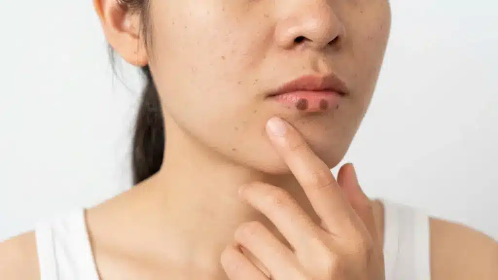Woman pointing at dark spots on her lower lip, with visible facial skin texture and a plain background