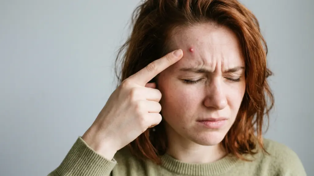 A close-up of a concerned young woman with red hair pointing at a large pimple on her forehead