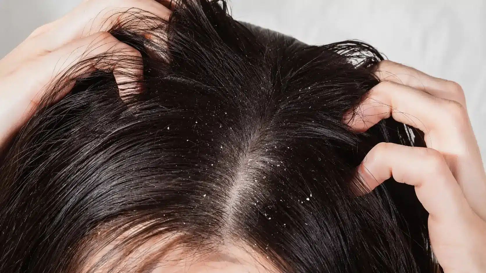 black hair parted to show white scalp flakes and visible dandruff buildup near the roots