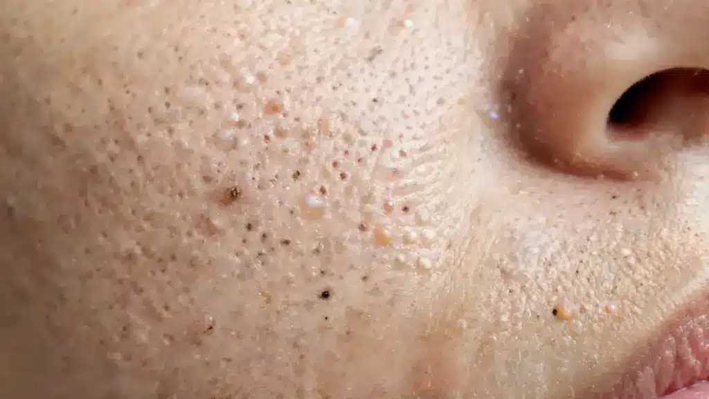 clogged pores with blackheads and whiteheads on close up facial skin texture