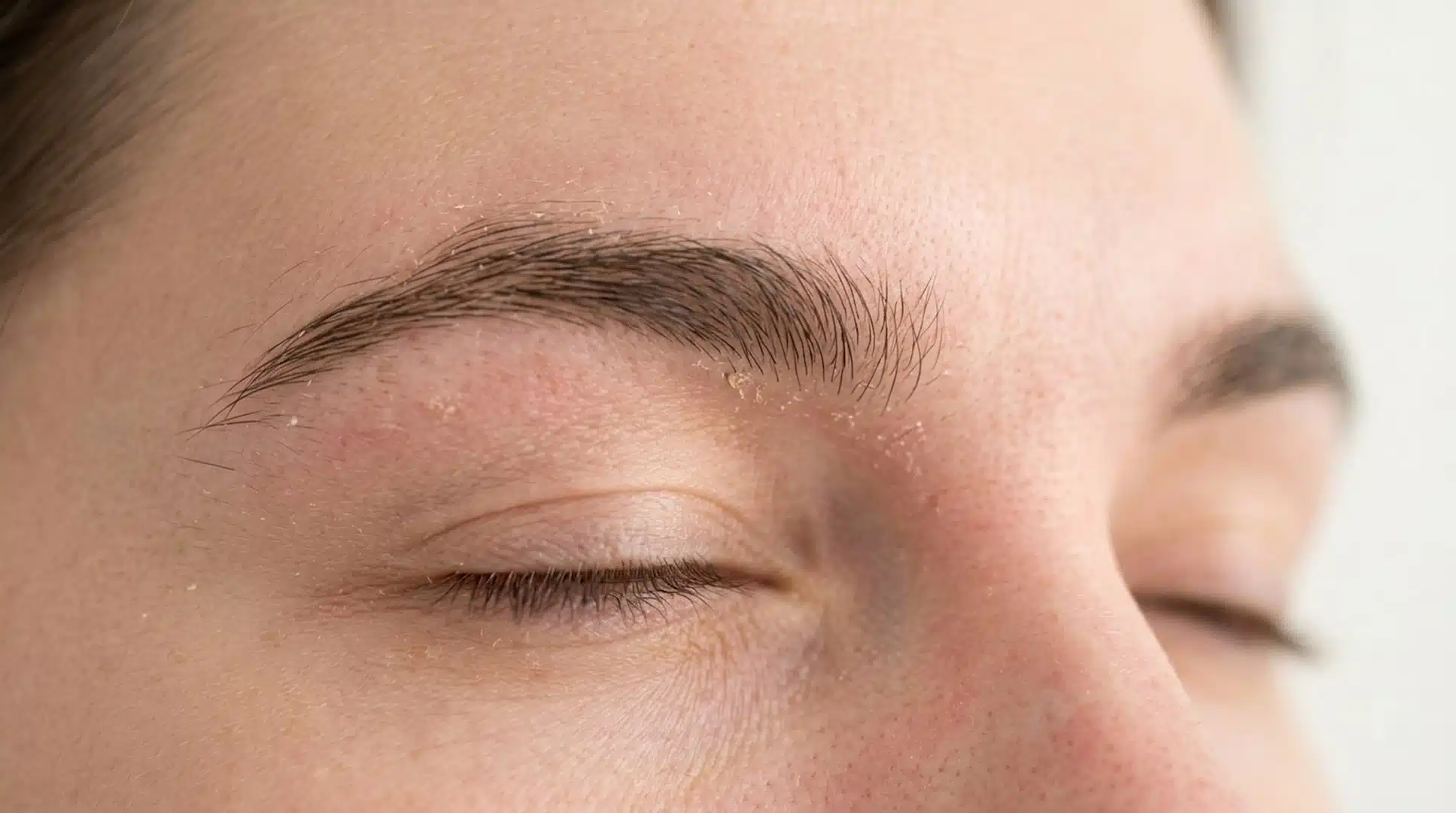 close up eyebrow area showing mild flakes and redness from seborrheic dermatitis