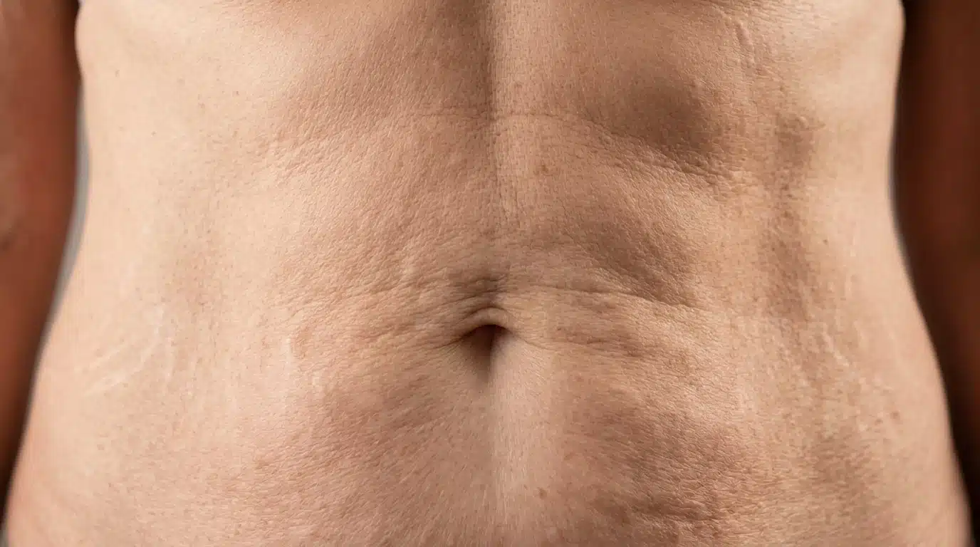 close up of abdominal skin showing crepey texture fine wrinkles and reduced elasticity after stretching