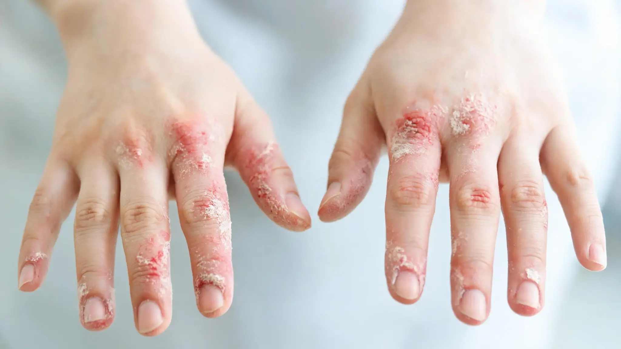 close up of hand eczema with redness dryness and peeling skin