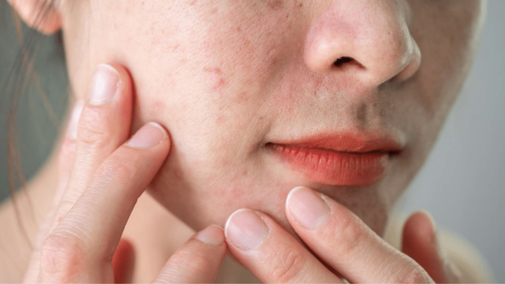 close up of textured skin showing uneven surface and visible pores on cheek area