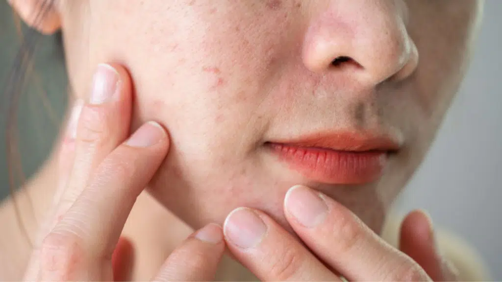 close up of textured skin showing uneven surface and visible pores on cheek area