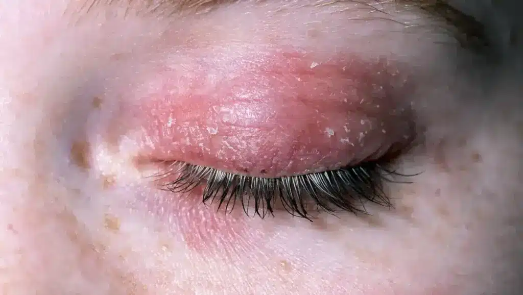 close up view of dry flaky eyelid skin with visible redness and peeling around the eye area