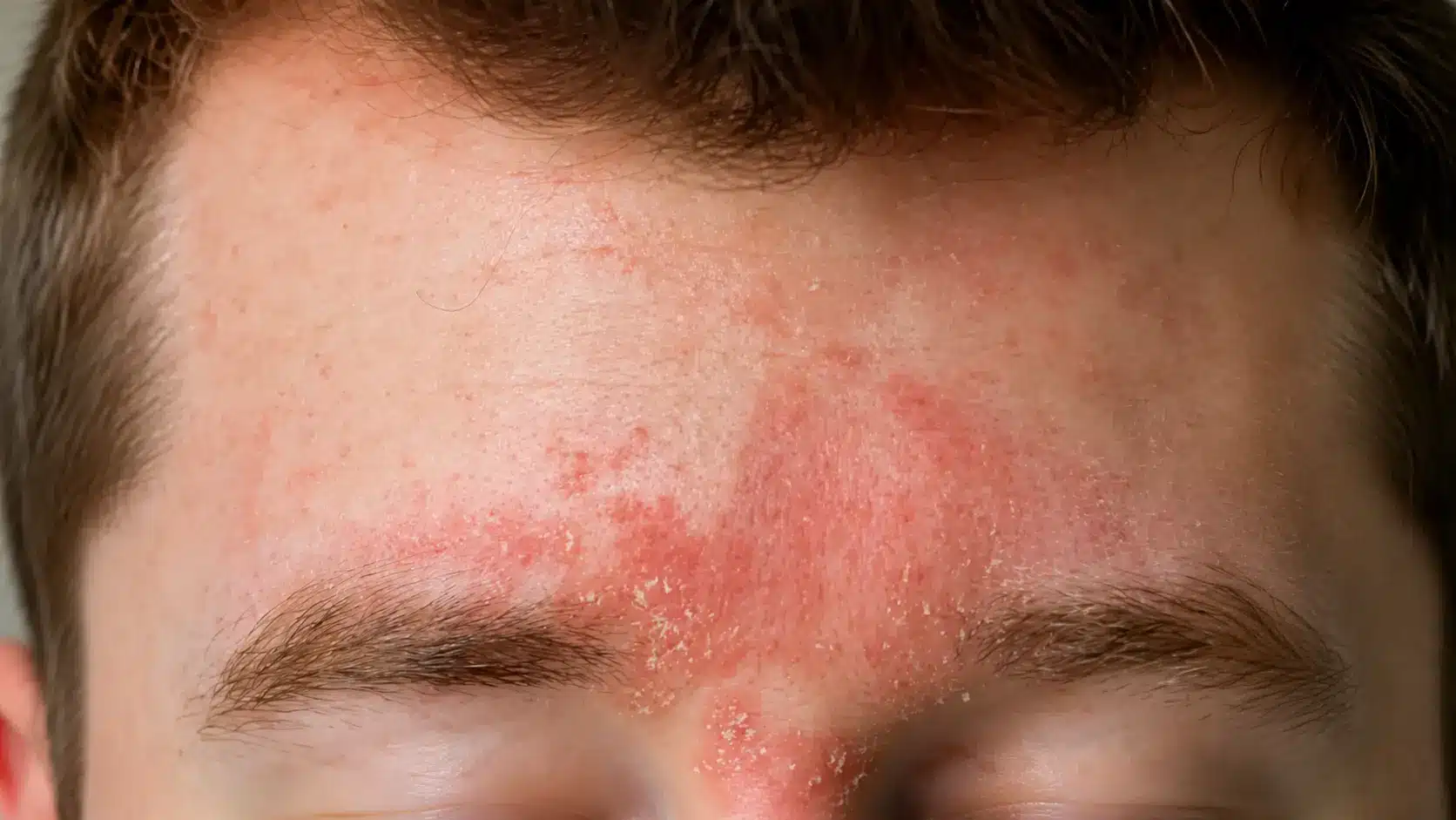 close up view of forehead with redness dry flakes and irritated skin near the hairline