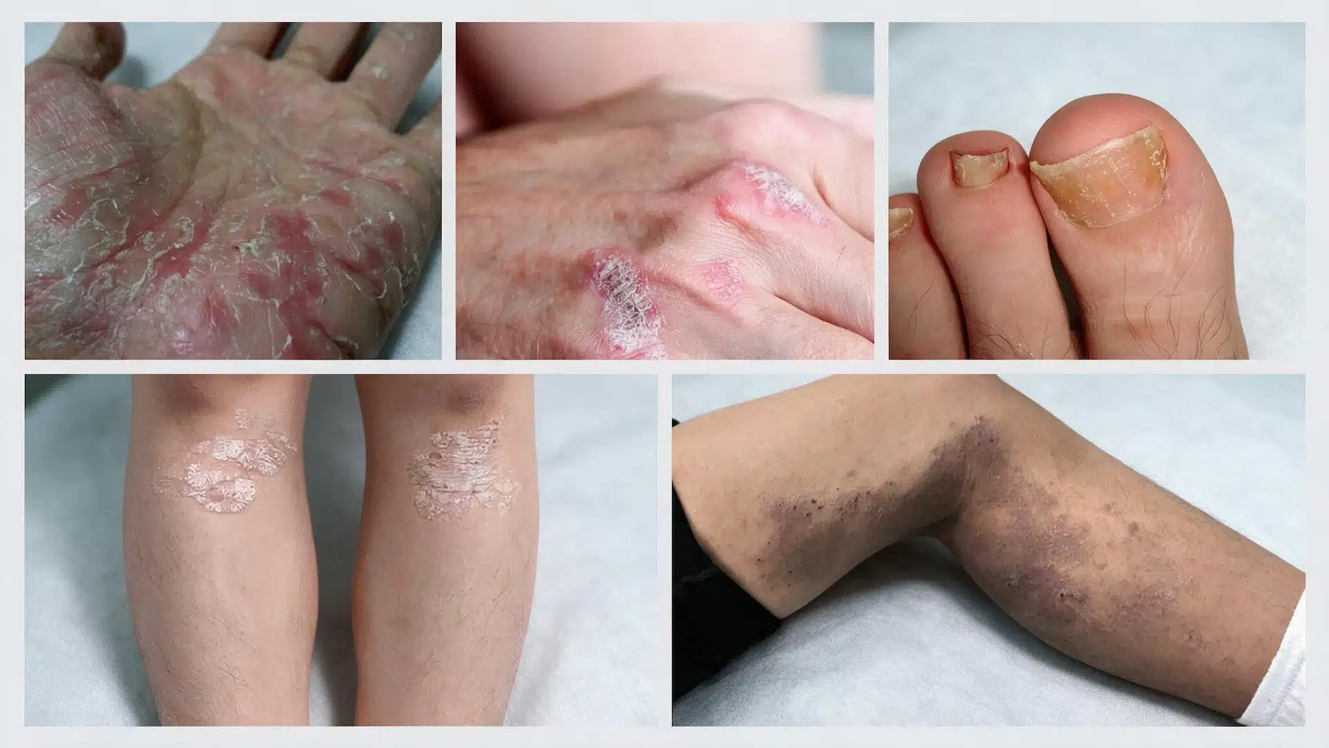 comparing eczema and psoriasis on hand and legs of different people