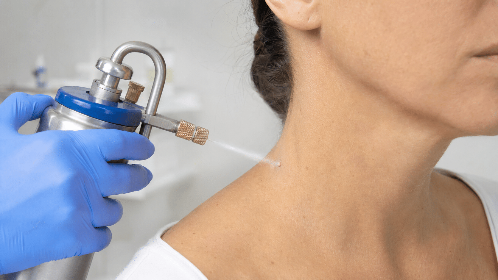 dermatologist using a liquid nitrogen cryotherapy device to freeze a small wart on a womans neck