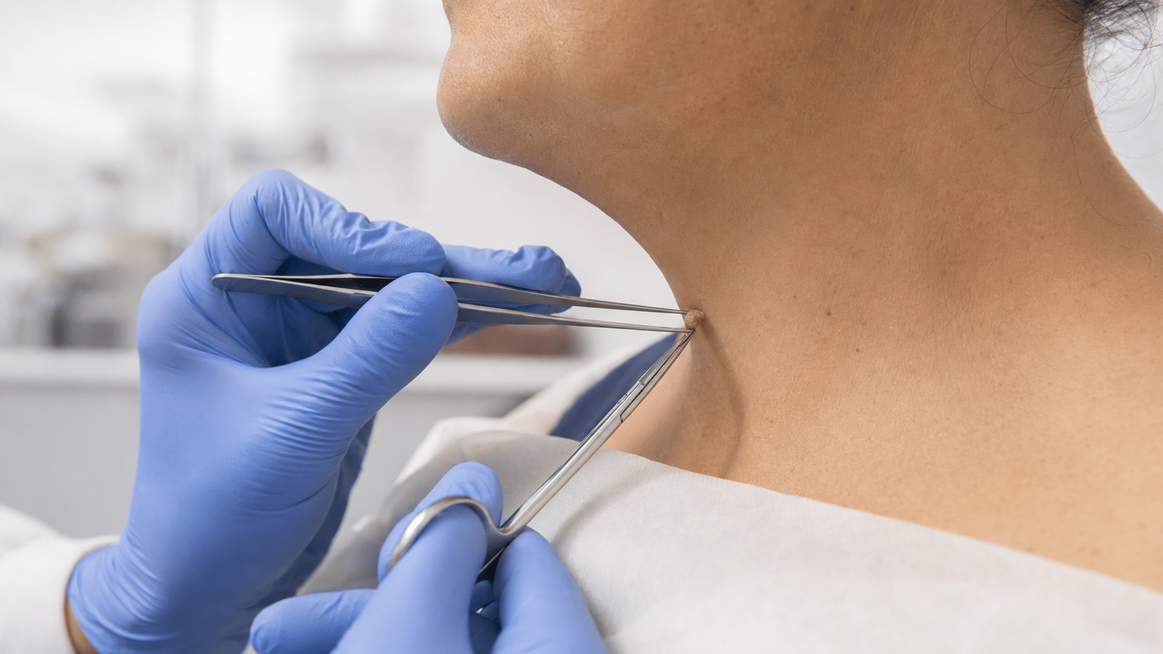 dermatologist using sterile forceps and surgical scissors to remove a small raised wart from a womans neck