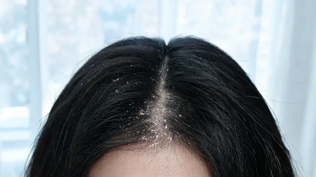 dry scalp with small white flakes near the hair roots