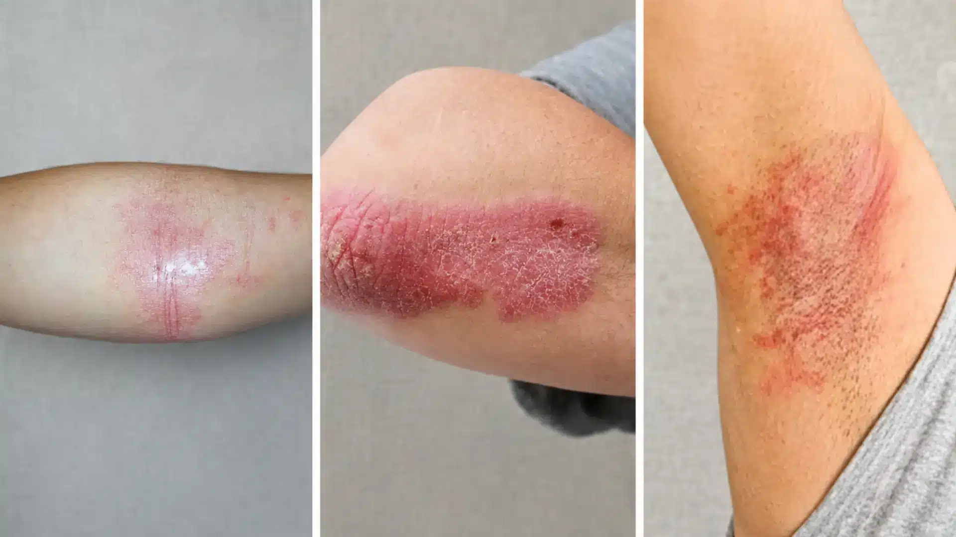 eczema and psoriasis comparison on arms, undeerarms, and hand with same background