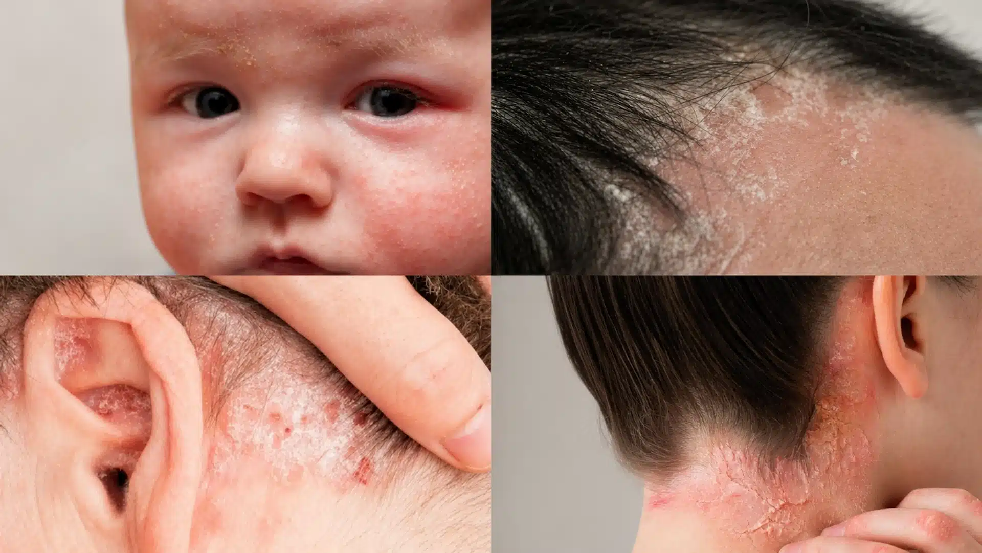 eczema and psoriasis on face and head a clinical comparison