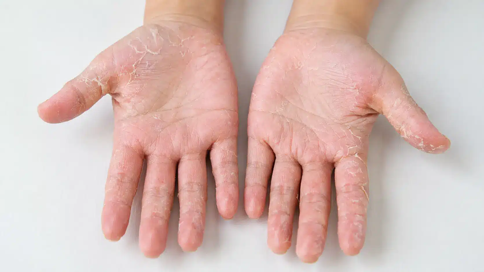 hands showing fungal infection with peeling dry skin and scaling on palms and fingers