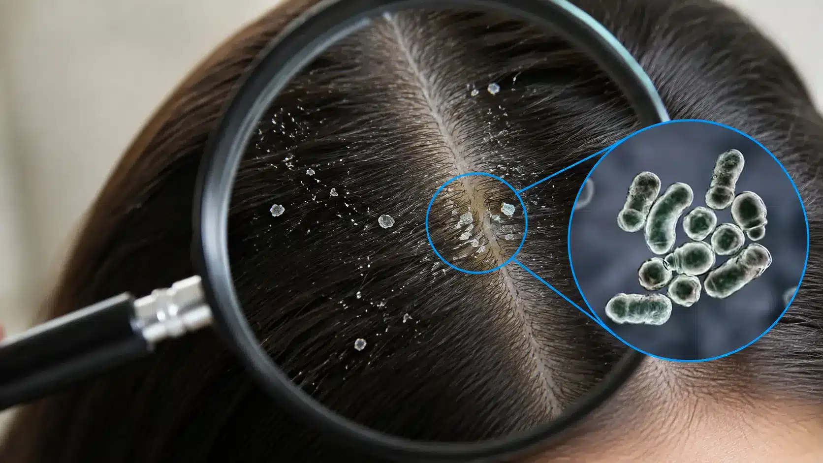 magnifying glass showing dandruff flakes and yeast activity on scalp