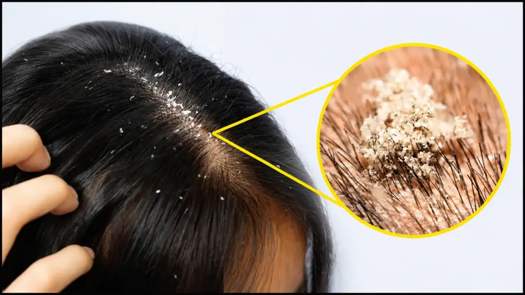 scalp with dandruff flakes showing close up view of flaky scalp condition