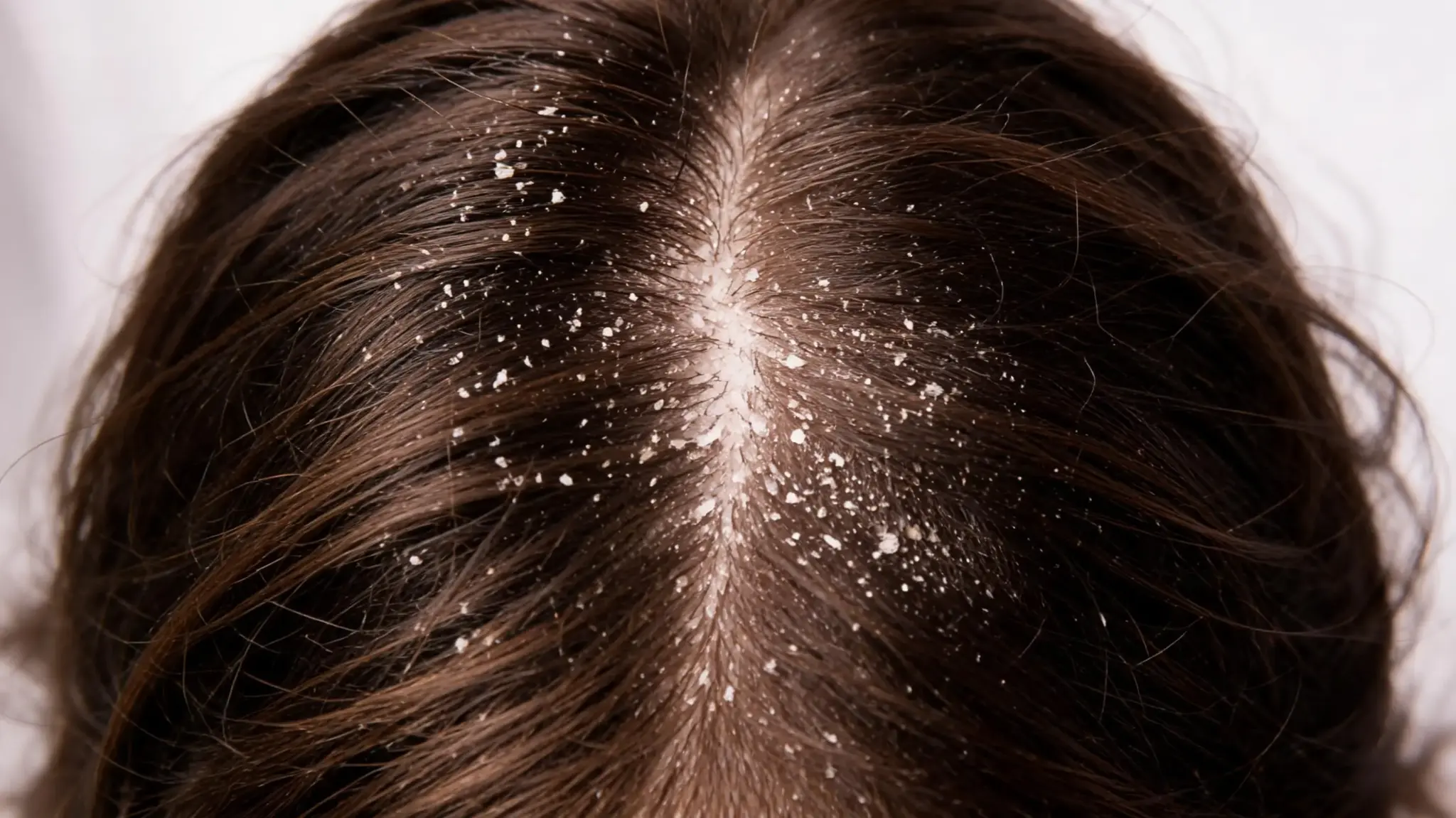 scalp with visible dandruff flakes on dark hair showing scalp irritation