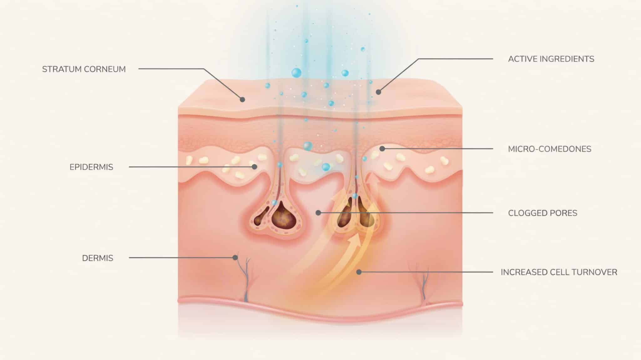 skin purging process showing clogged pores moving toward the surface after active ingredients