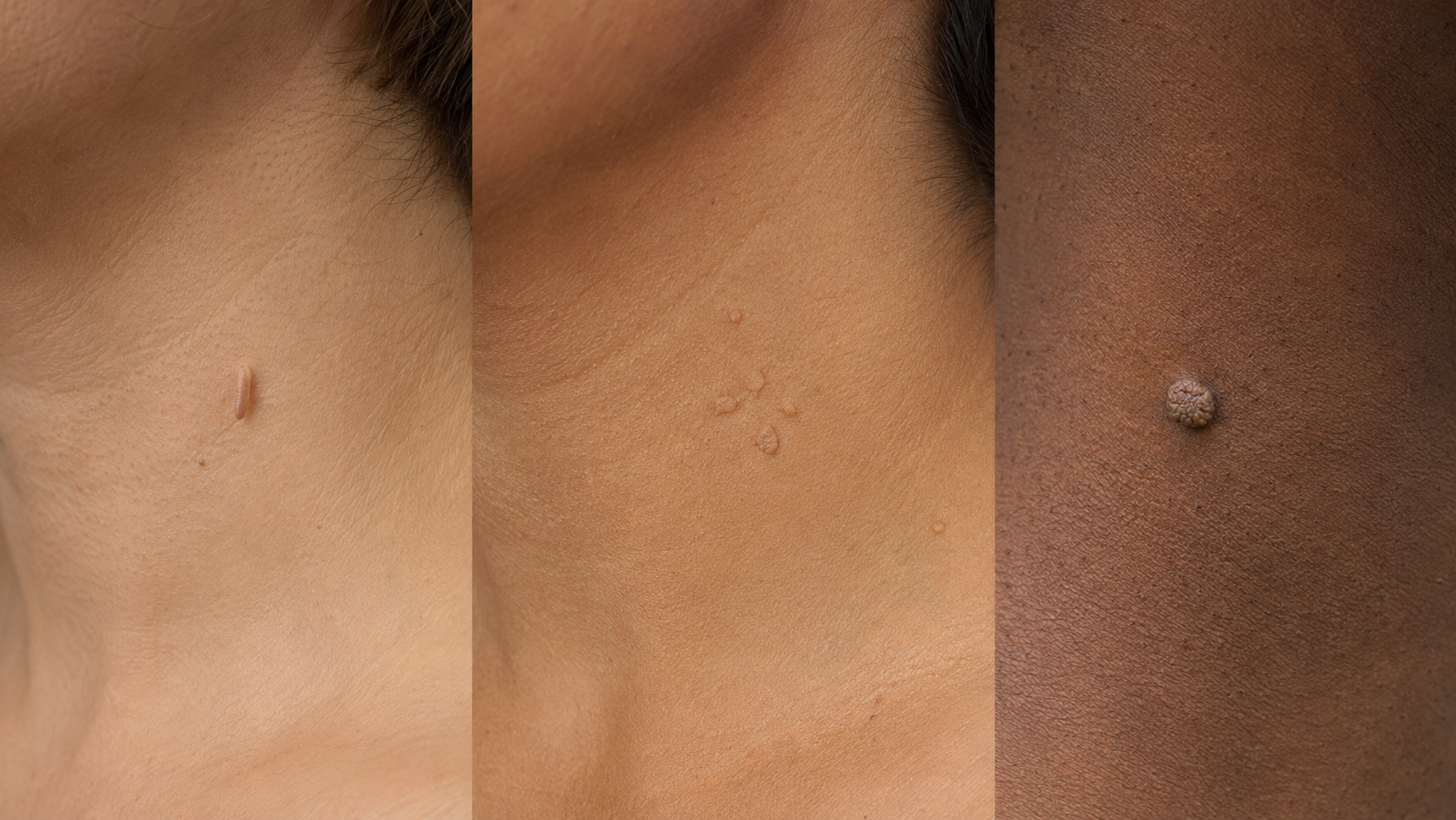 three panel collage showing filiform flat and common warts on neck skin across three different skin tones
